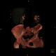 Parapelvic cysts of kidney, Paramo's syndrome, VRT: CT - Computed tomography